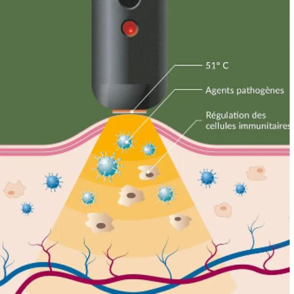Herpotherm stick chauffant contre l'herpes labial